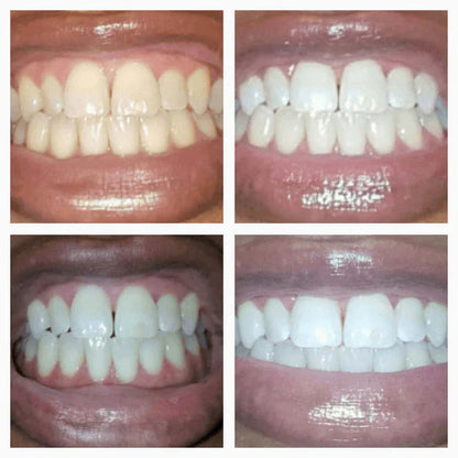 Cvreoz® SmileFitPro Zahnaufhellungsstift