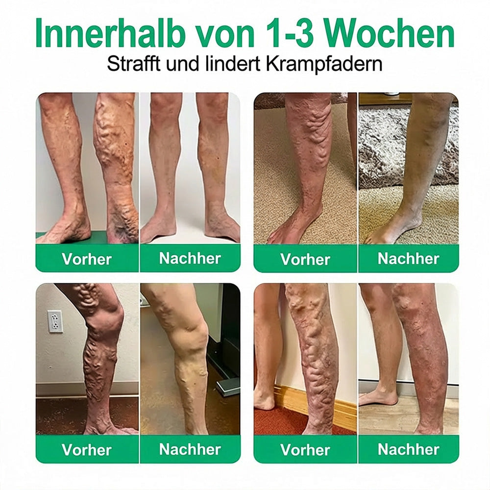 👨‍⚕️🔥Healrize® VeinEase Mikronadel-Technologie⚡Spürbare Wirkung in Tagen – nachhaltige Verbesserung (offer)