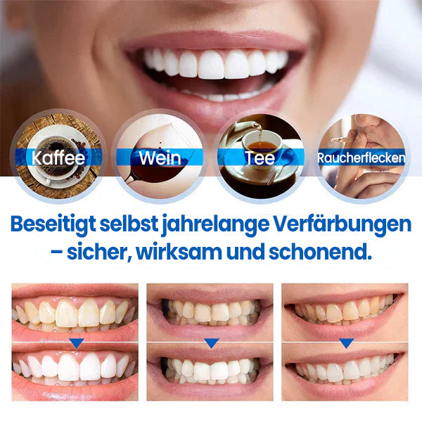 Cvreoz® SmileFitPro Zahnaufhellungsstift