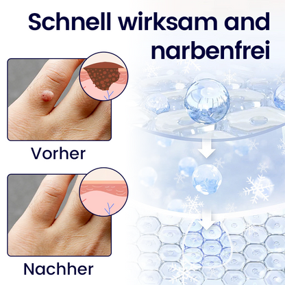 ❄️ Cvreoz® WartErase Cryo-Freeze Spray — Schnelle Entfernung von Warzen & Hautanhängseln