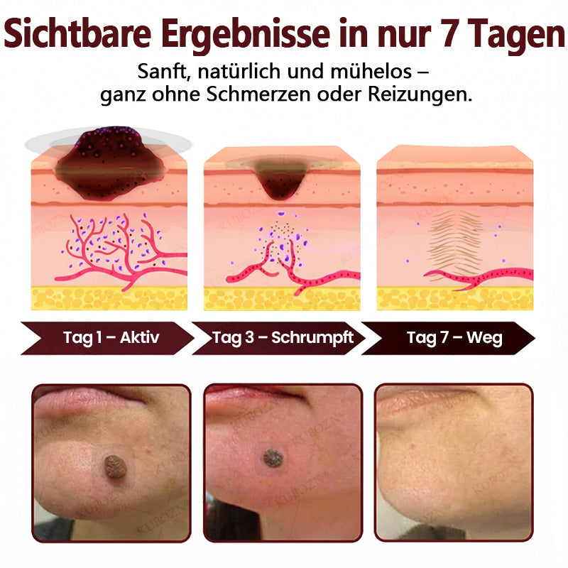 KUBOZN® OryzaDarts TAG’GONE – Schmerzfreie Entfernung an der Wurzel dank Schwarzer-Reis-Mikrotechnologie ✨ (offer)