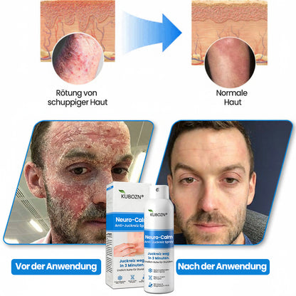 ✅Kubozn® Magnesium Kräuter-Psoriasis Spray  (offer)
