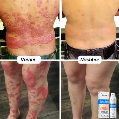 ✅Kubozn® Magnesium Kräuter-Psoriasis Spray  (offer)