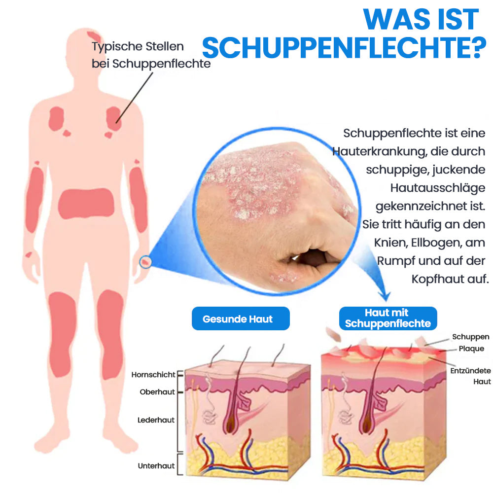 ✅Kubozn® Magnesium Kräuter-Psoriasis Spray  (offer)
