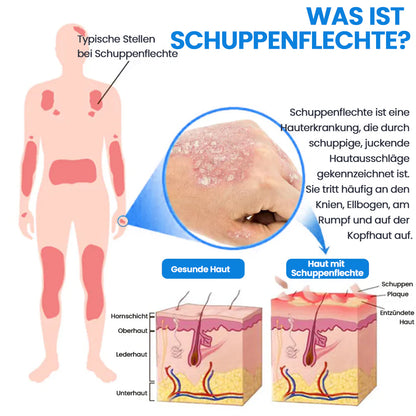 ✅Kubozn® Magnesium Kräuter-Psoriasis Spray  (offer)
